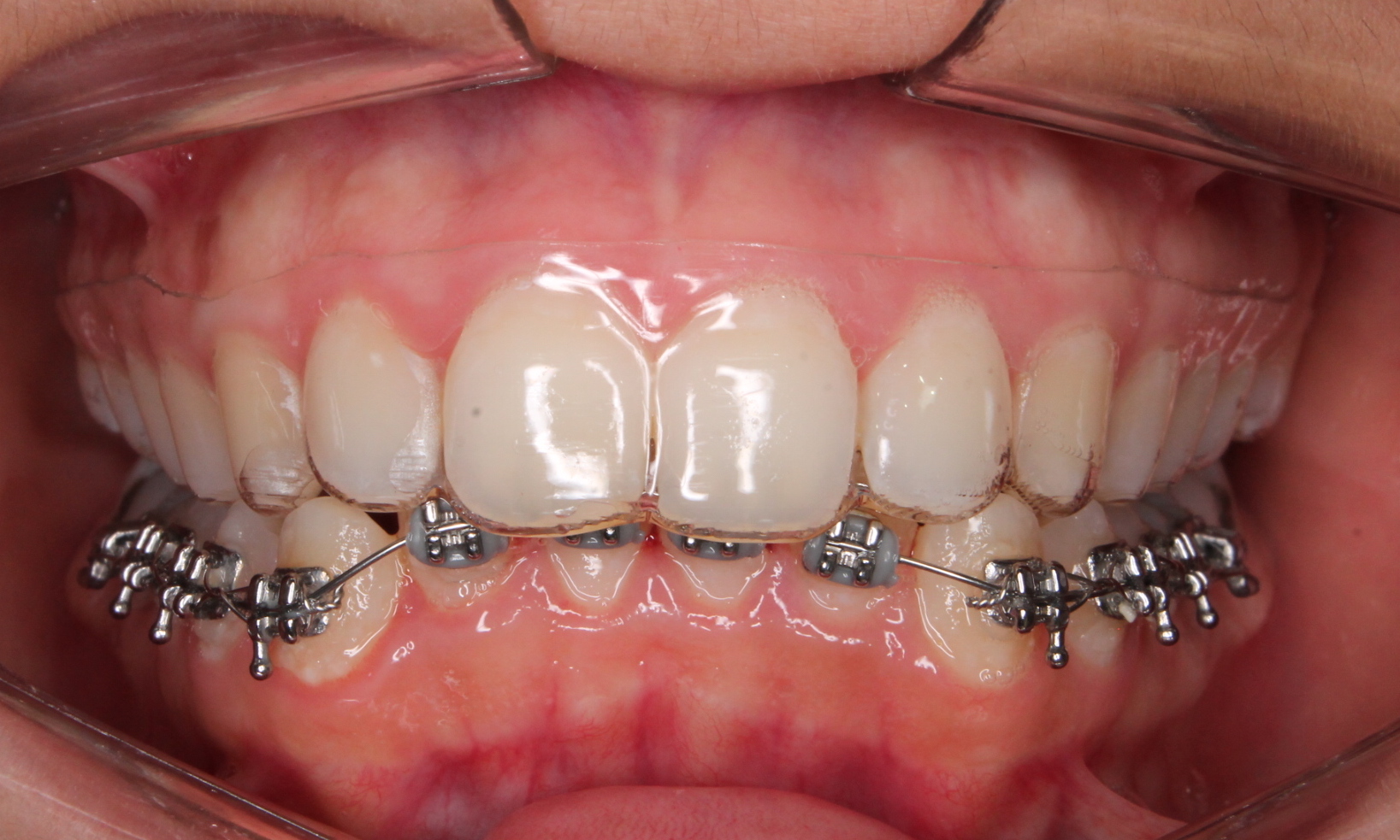 Nova Geração de Alinhadores em Ortodontia – Mais Rápido e