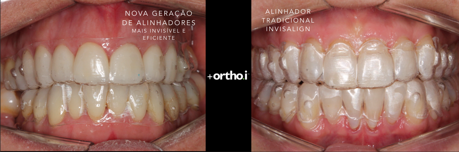 Antes e Depois Invisalign - Mori Ortodontia